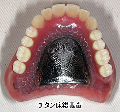 チタン床総義歯